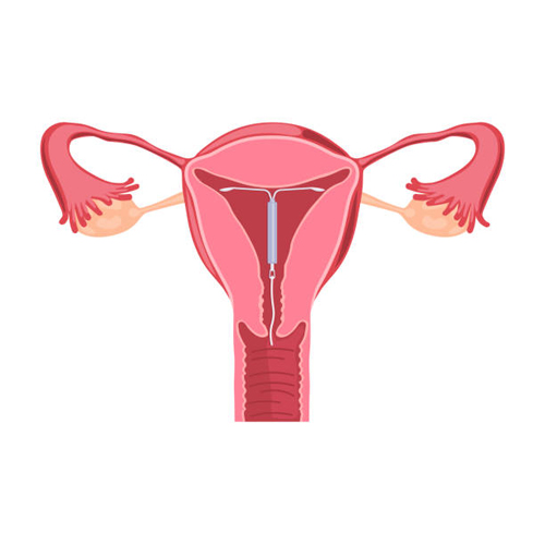 Can You Use A Menstrual Cup With and IUD?