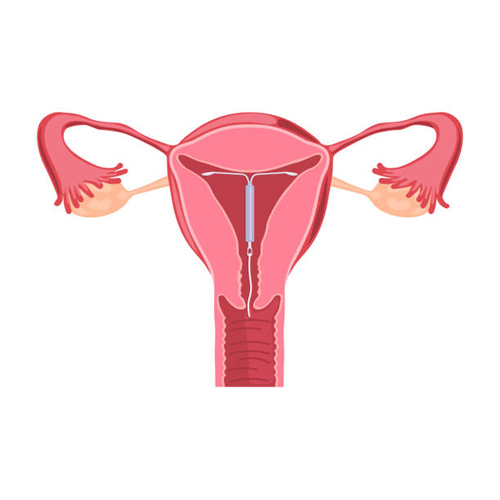Menstrual cup on sale and iud